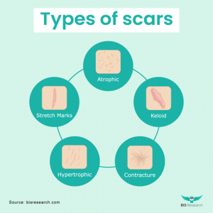 Scar Management Market