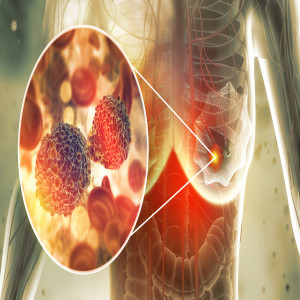 Breast Cancer Screening