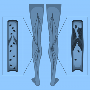 Deep Venous Disease Treatment Devices Market