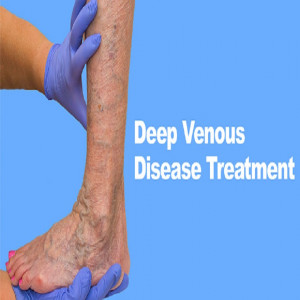 Deep Venous Disease Treatment Devices