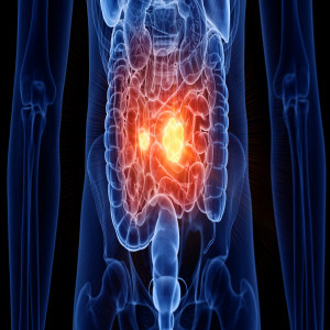 Colorectal Cancer Screening