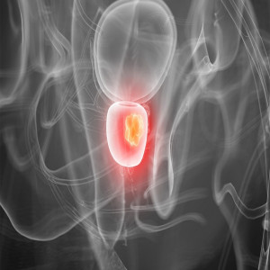 US Prostate cancer testing market
