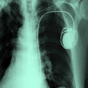 Global Next Generation Pacemaker & ICDs Market