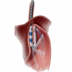 Global GERD Drug and Devices Market 