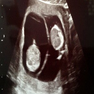 Global Non-Invasive Prenatal Testing (NIPT) Market