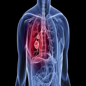 Global Cancer Imaging Systems
