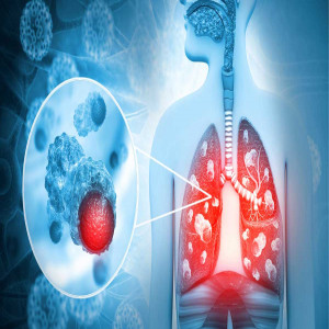 Extensive stage small cell lung cancer